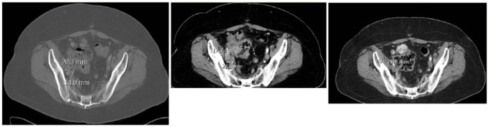 A Recurrent Platinum Refractory Ovarian Cancer Patient With a Partial Response After RRx-001 Resensitization to Platinum Doublet.