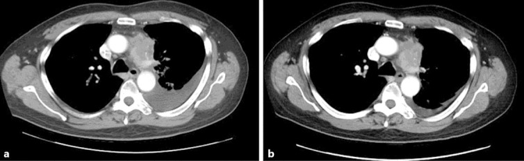 RRx-001 in Refractory Small-Cell Lung Carcinoma: A Case Report of a Partial Response after a Third Reintroduction of Platinum Doublets.