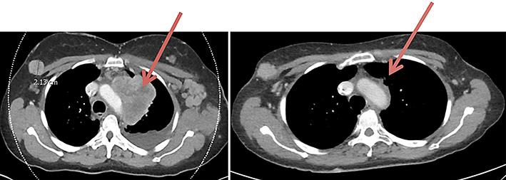RRx-001 Priming of PD-1 Inhibition in the Treatment of Small Cell Carcinoma of the Vagina: A Rare Gynecological Tumor.